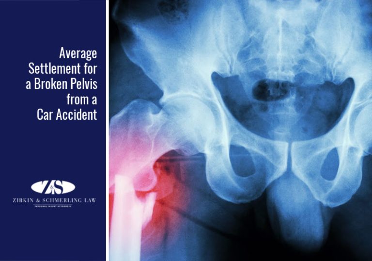 average-compensation-for-a-broken-pelvis-in-a-car-accident